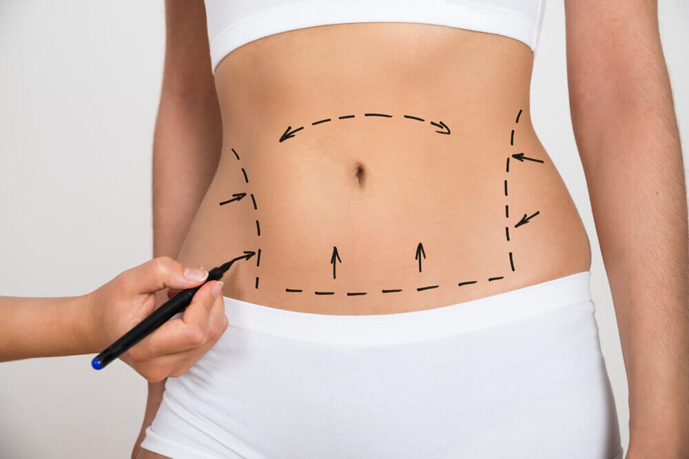 Abdominoplastia: Como é o pós-cirúrgico?