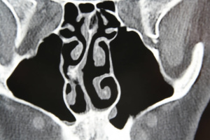 rinosseptoplastia - desvio de septo