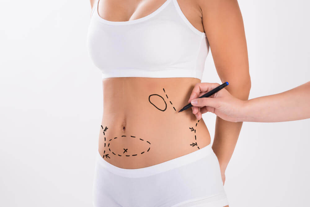 Abdominoplastia:  Para quem é indicada?