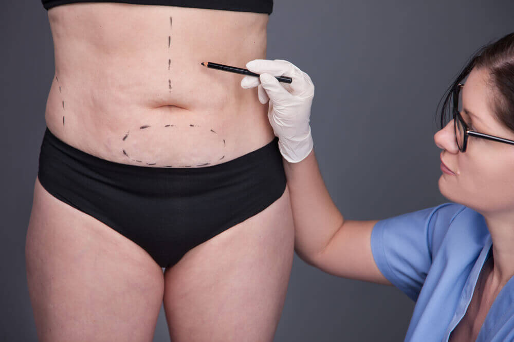 Abdominoplastia pós bariátrica