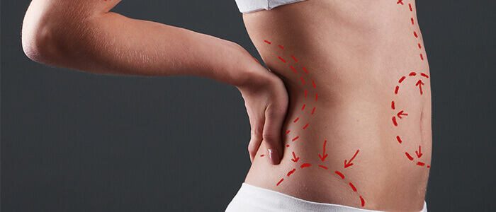 Conheça os diferentes tipos de lipoaspiração