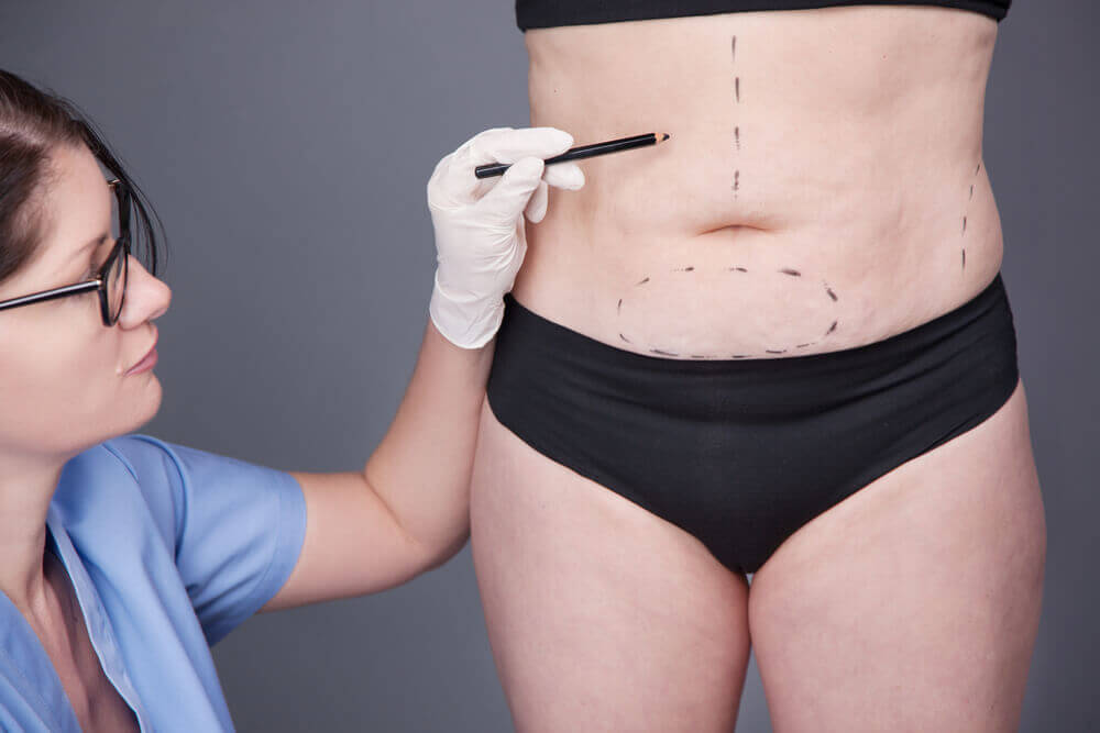 O que é a abdominoplastia em âncora?