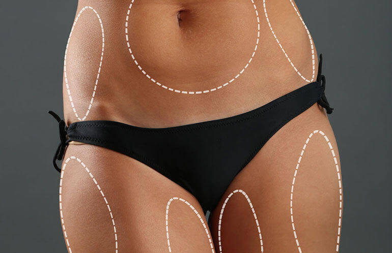 5 fatores que podem influenciar nos resultados de uma lipoaspiração