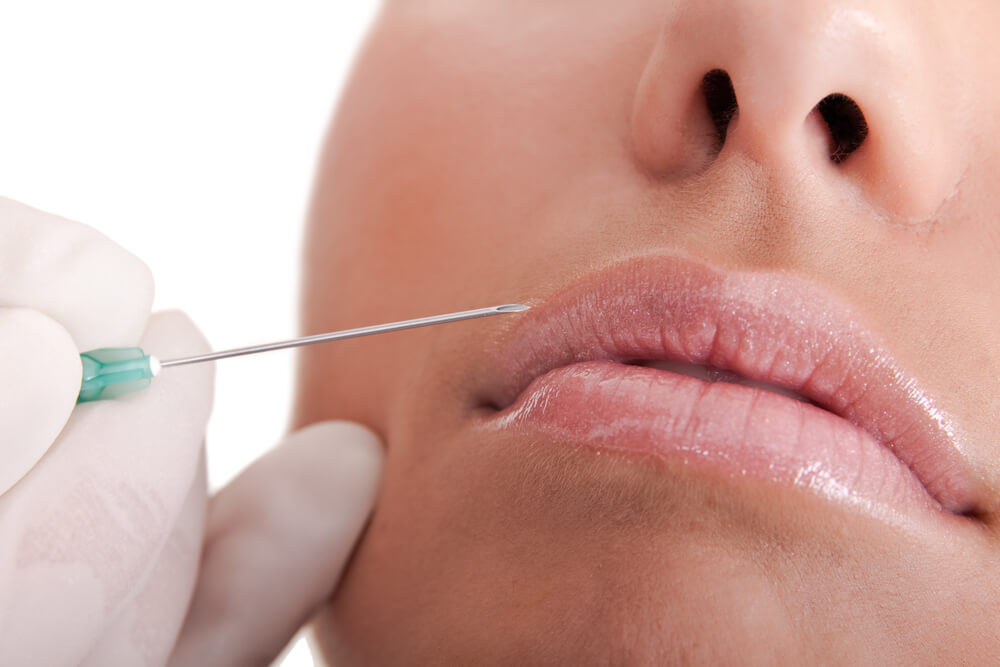 Principais vantagens do preenchimento labial