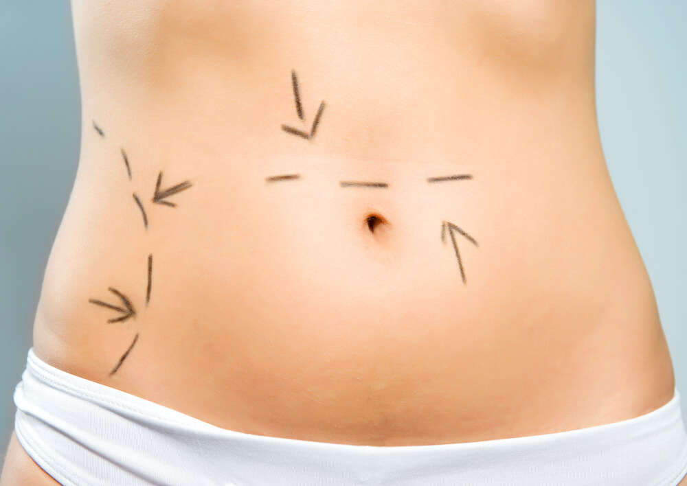 Quando fazer lipoaspiração na barriga?