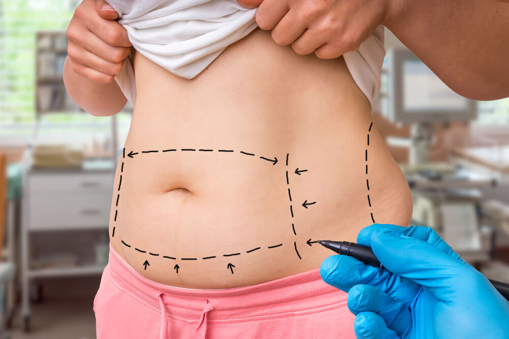 Quando recorrer a cirurgia de abdominoplastia?