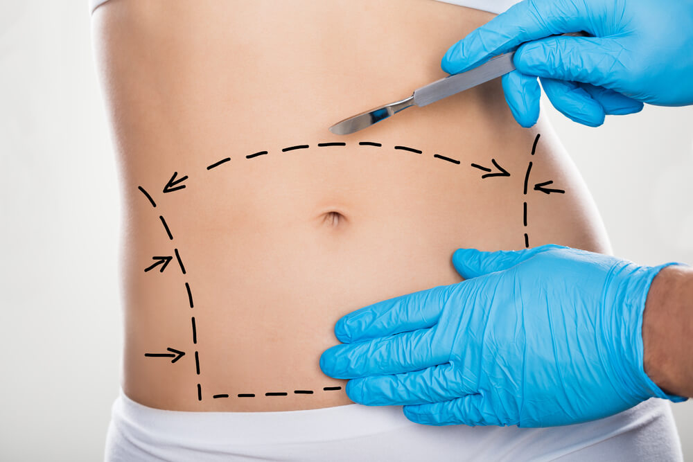 Qual o nome da cirurgia plástica na barriga?