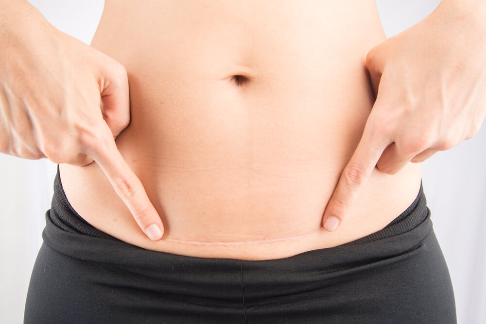 Abdominoplastia cicatriz: Tudo o que você precisa saber sobre a cicatriz após a cirurgia