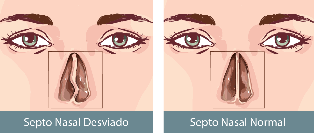 Cirurgia para o desvio de septo