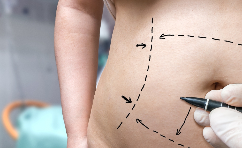 7 principais dúvidas sobre Abdominoplastia