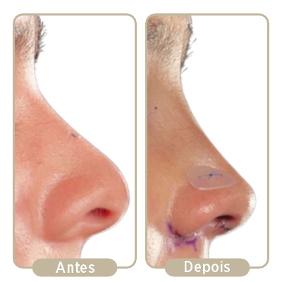 Antes e depois da rinoplastia.