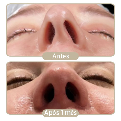 Antes e depois (1 mês) da rinoplastia.