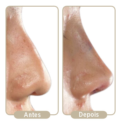 Antes e depois da rinoplastia.