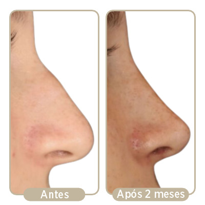 Antes e depois (após 2 meses) da rinoplastia.