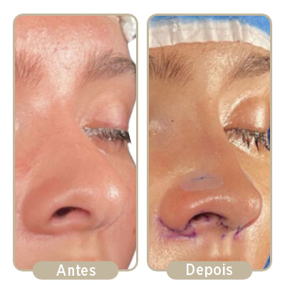 Antes e depois da rinoplastia.