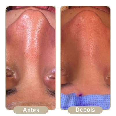 Antes e depois da rinoplastia.