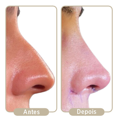 Antes e depois da rinoplastia.