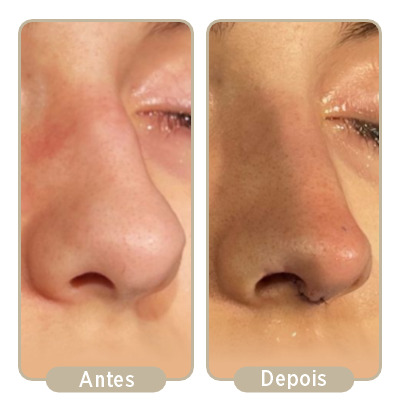 Antes e depois da rinoplastia.