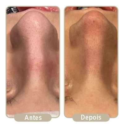 Antes e depois da rinoplastia.