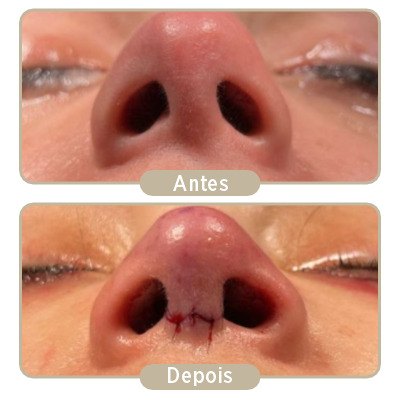 Antes e depois da rinoplastia.