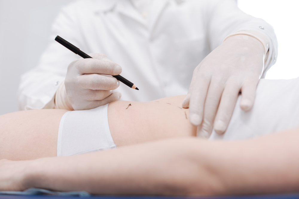 Médico fazendo marcações na paciente para realizar uma cirurgia com intuito de reduzir a flacidez abdominal