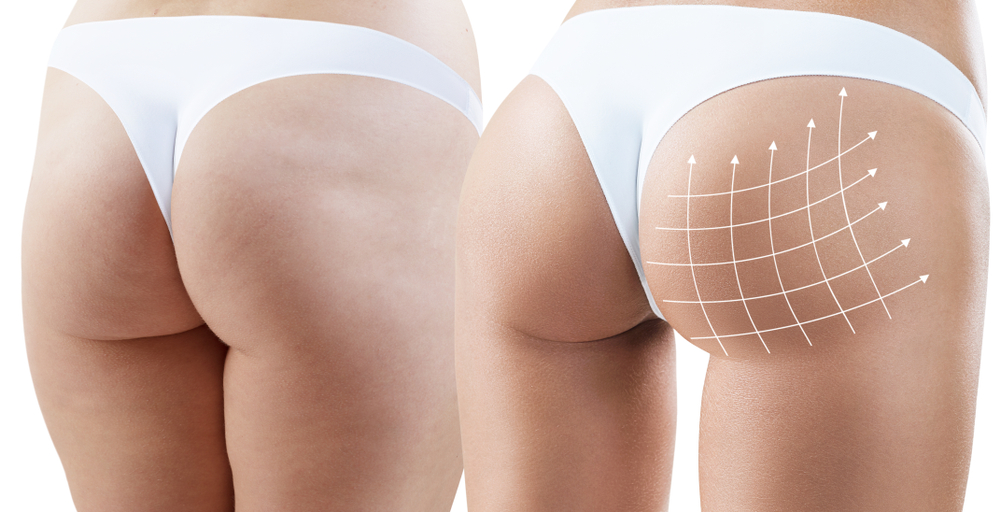 Gluteoplastia: Saiba tudo sobre a Plástica no Bumbum