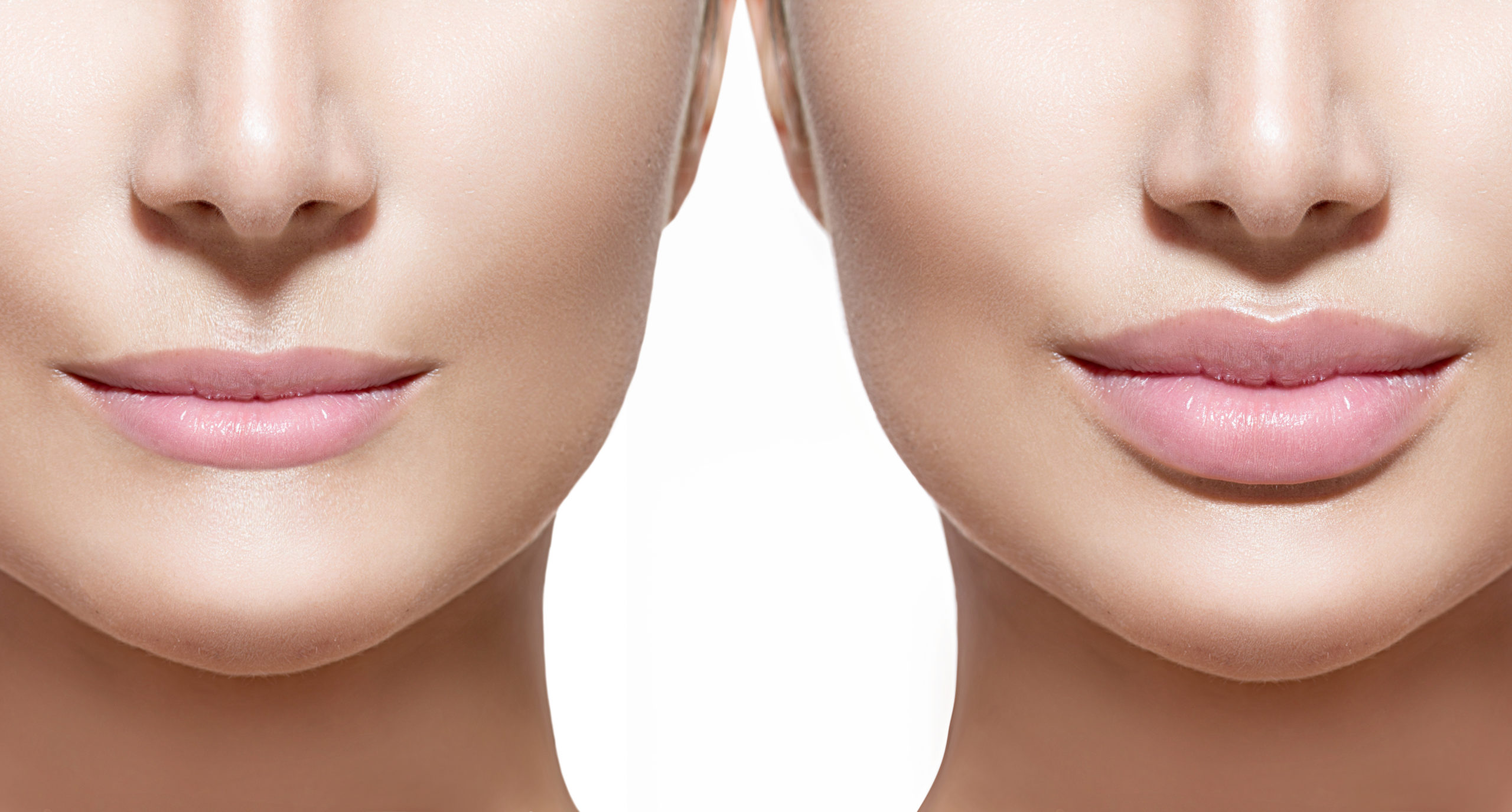 O preenchimento labial: antes e depois.