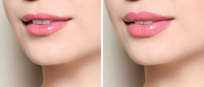 Lábios: o procedimento de preenchimento com gordura