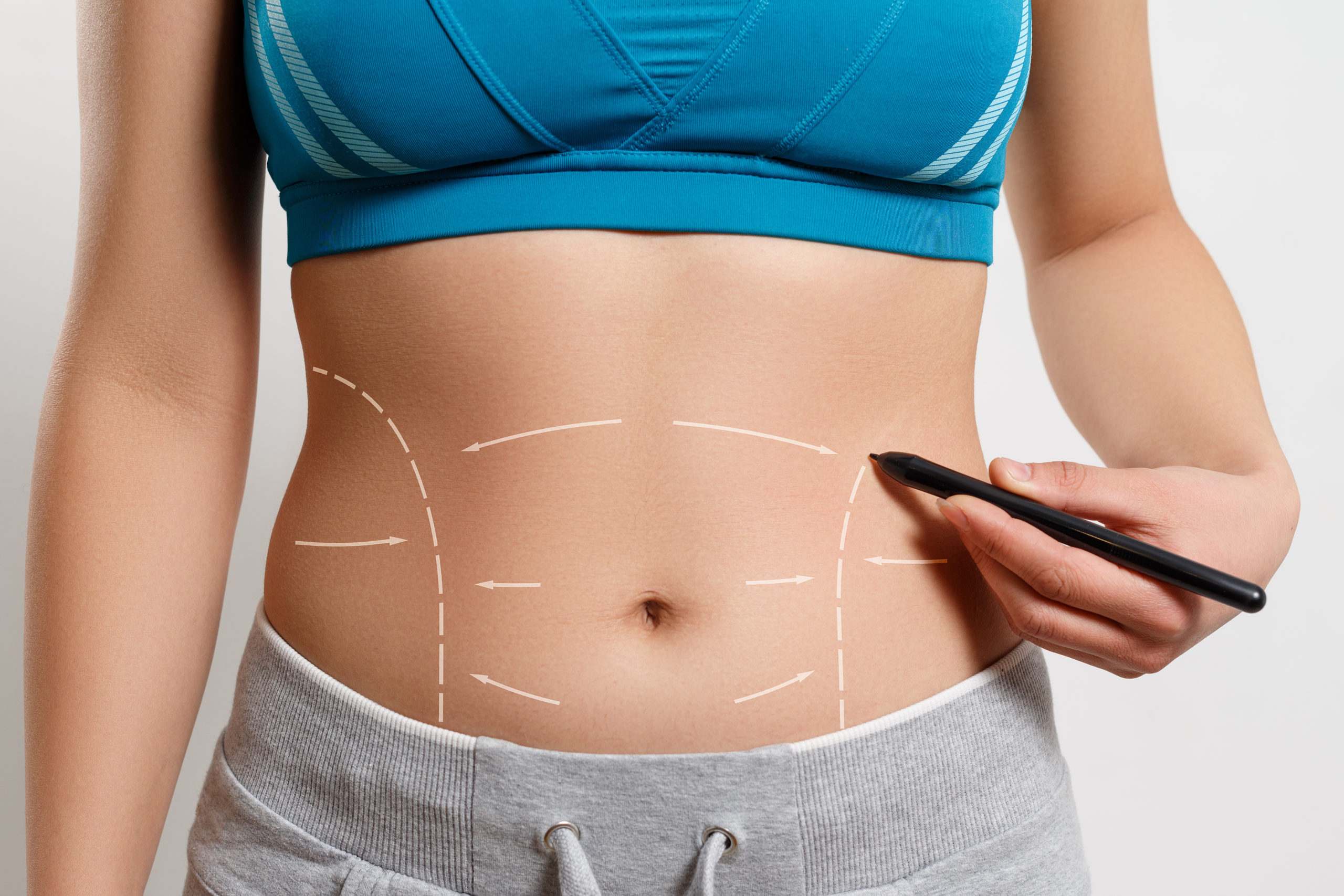 Tudo sobre abdominoplastia