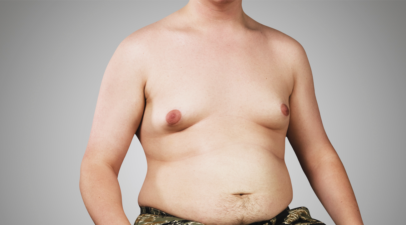 Ginecomastia – Quadro clínico e tratamento