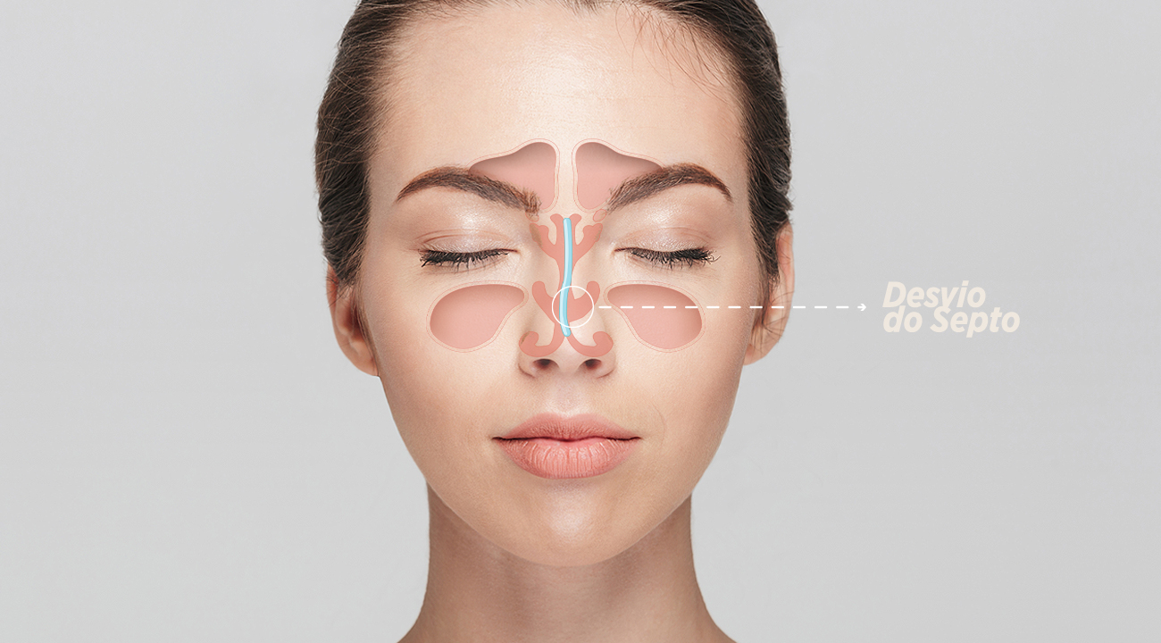 Desvio de Septo – Problemas e soluções