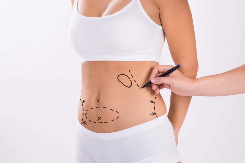 Abdominoplastia reduz flacidez e gordura. Saiba tudo!