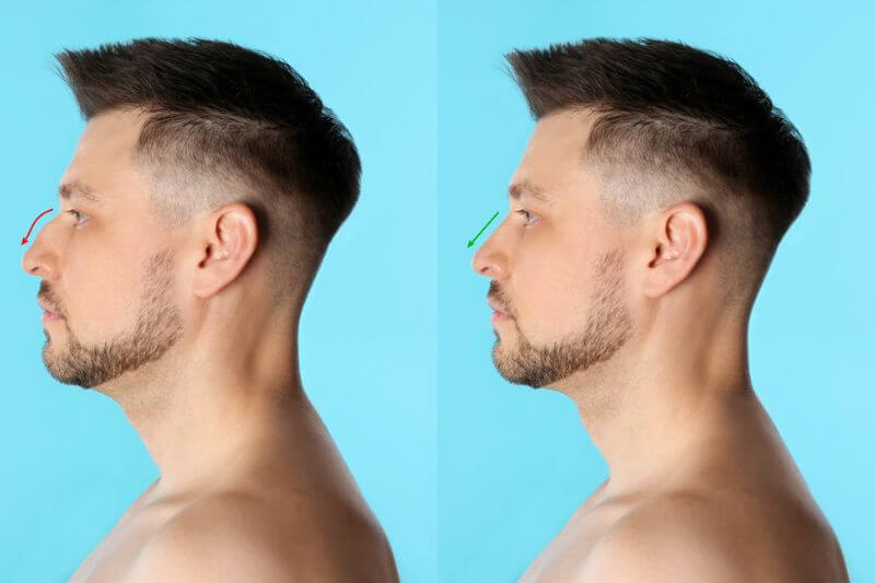 Rinoplastia masculina: tudo que você precisa saber
