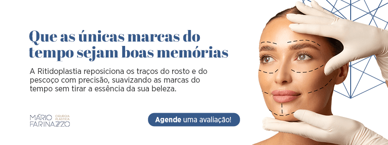 Que as únicas marcas do tempo sejam boas memórias. A Ritidoplastia reposiciona os traços do rosto e do pescoço com precisão, suavizando as marcas do tempo sem tirar a essência da sua beleza. Agende uma avaliação! Mário Farinazzo, cirurgia plástica!