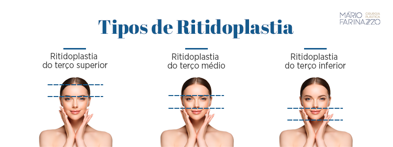 Tipos de Ritidoplastia: Ritidoplastia do terço superior, Ritidoplastia do terço médio e Ritidoplastia do terço inferior.