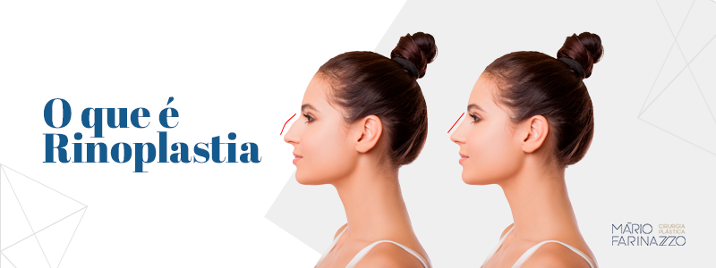 O que é Rinoplastia?