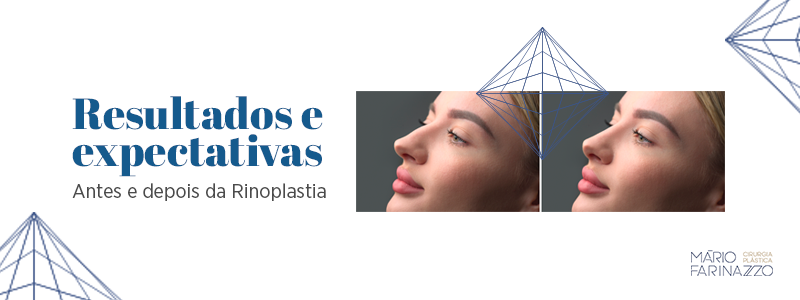 Resultados e expectativas: antes e depois da Rinoplastia.