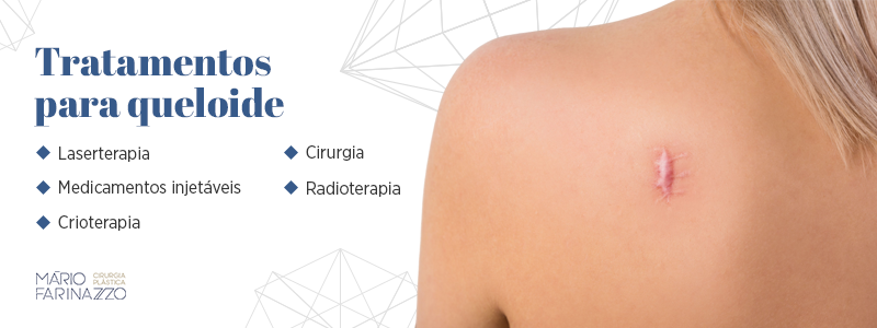 Tratamentos para queloide: laserterapia, medicamentos injetáveis, crioterapia, cirurgia e radioterapia.