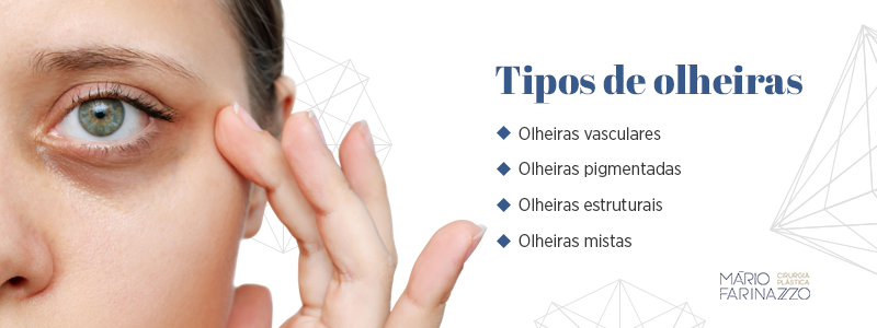 Tipos de olheiras: olheiras vasculares, olheiras pigmentadas, olheiras estruturais e olheiras mistas.