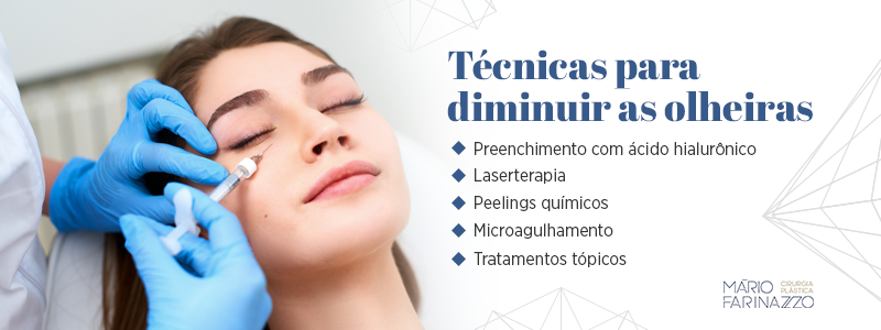 Técnicas para diminuir olheiras: preenchimento com ácido hialurônico, laserterapia, peelings químicos, microagulhamentos e tratamentos tópicos.