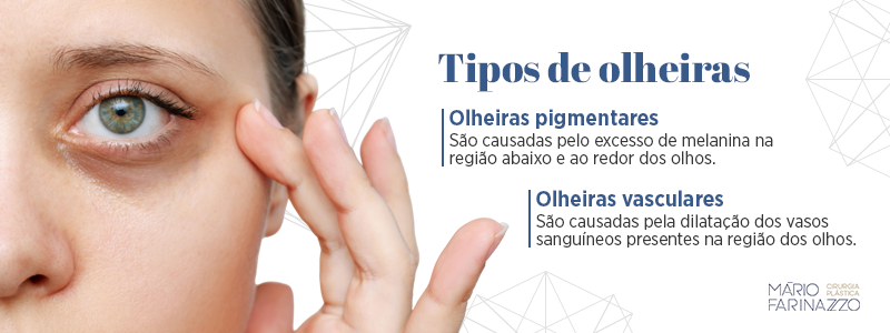 Tipos de olheiras. Olheiras pigmentares: são causadas pelo excesso de melanina na região abaixo dos olhos. Olheiras vasculares: são causadas pela dilatação dos vasos sanguíneos presentes na região dos olhos.