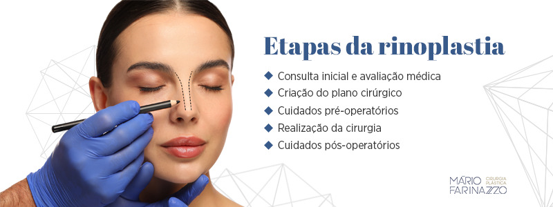 Etapas da rinoplastia: consulta inicial e avaliação médica, criação do plano cirúrgico, cuidados pré-operatórios, realização da cirurgia e cuidados pós-operatórios.