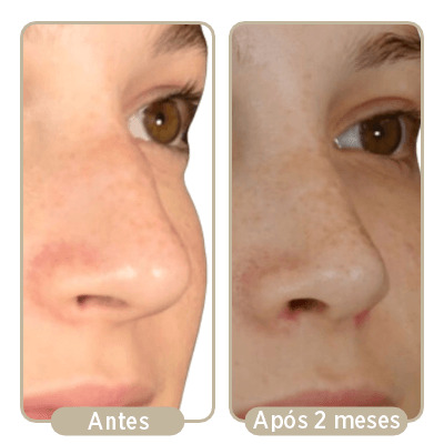 Duas imagens de antes e depois da rinoplastia após dois meses