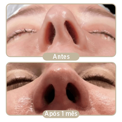 Duas imagens de antes e depois da rinoplastia após um mês