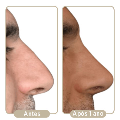 Duas imagens de perfil de antes e depois da rinoplastia após um ano