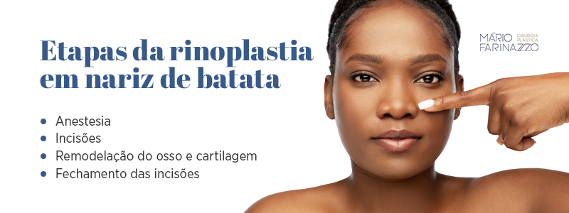Etapas da rinoplastia em nariz de batata: 1)anestesia, 2)incisões, 3)remodelação do osso e cartilagem e
4)fechamento das incisões.