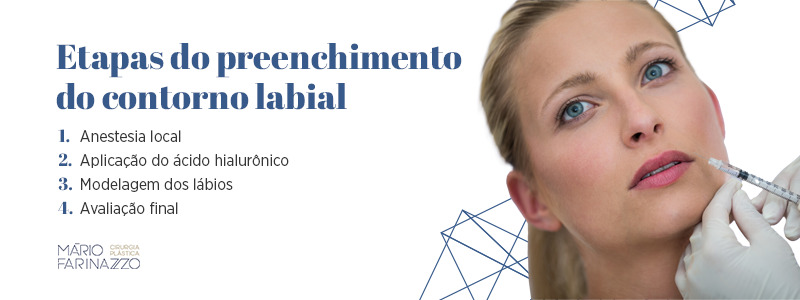 Etapas do preenchimento do contorno labial: 1. Anestesia local 2. Aplicação do ácido hialurônico 3. Modelagem dos lábios 4. Avaliação final.