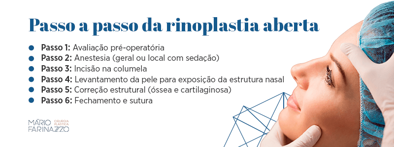 Passo a passo da rinoplastia aberta. Passo 1: Avaliação pré-operatória. Passo 2: Anestesia (geral ou local com sedação). Passo 3: Incisão na columela. Passo 4: Levantamento da pele para exposição da estrutura nasal. Passo 5: Correção estrutural (óssea e cartilaginosa). Passo 6: Fechamento e sutura.